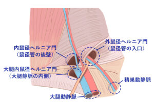 femoral-hernia